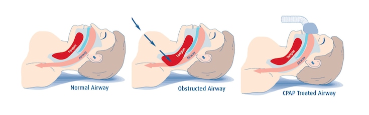 Airways